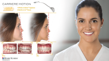 Girl before and after Reveal Aligners